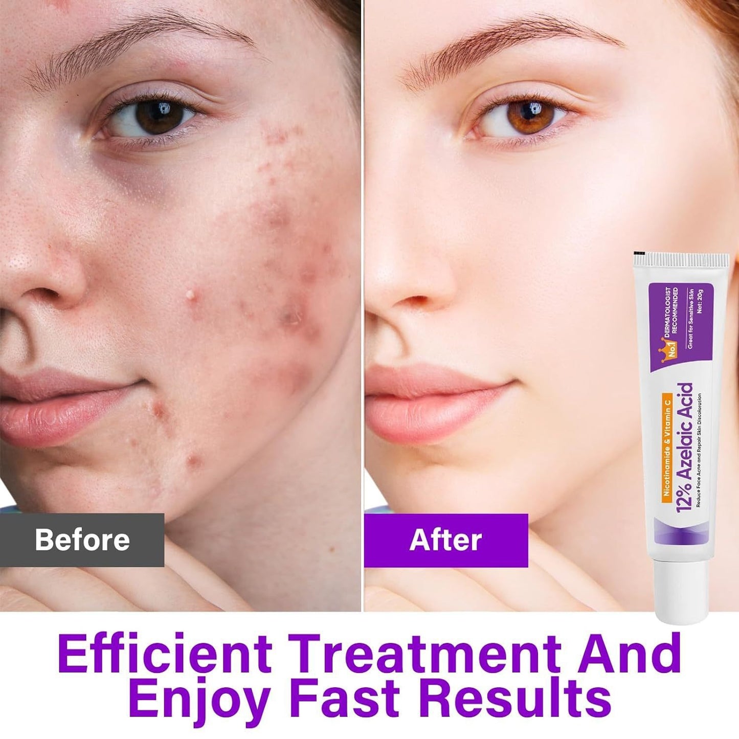 12% AzelaicAcid Cream