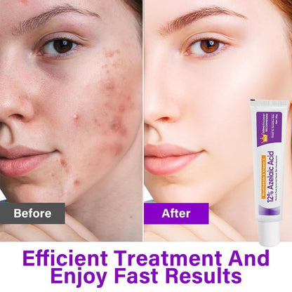 12% AzelaicAcid Cream